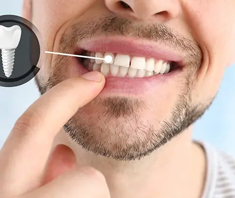 missing tooth image