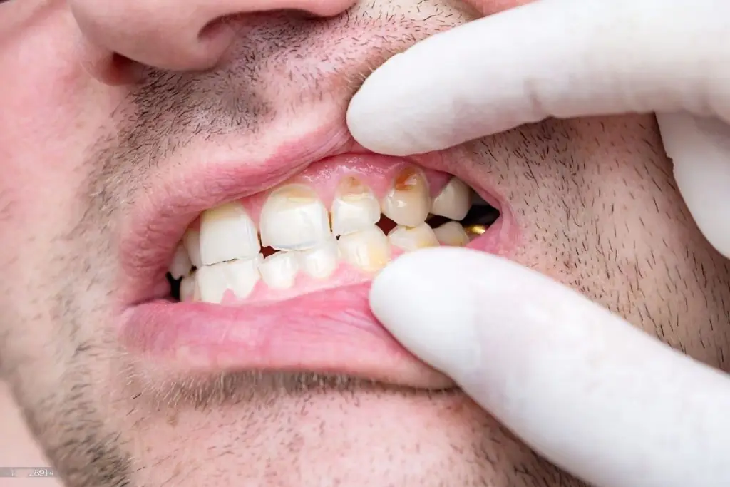 tooth decay image