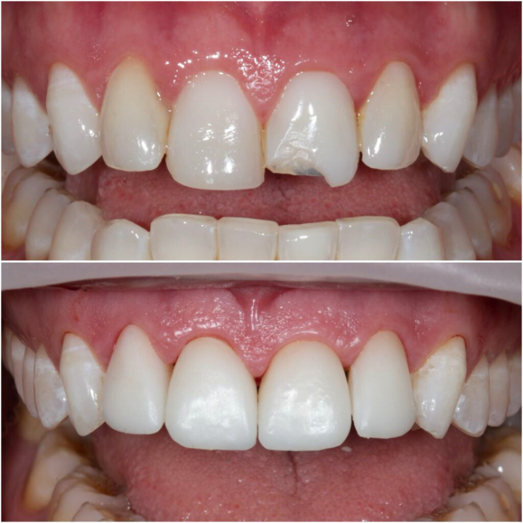 Before and after of 4 3D printed hybrid veneers — Limitless Dental Jersey City
