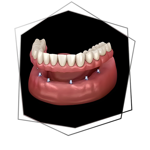 All-on-X full-arch implant-supported prosthesis — Limitless Dental Jersey City