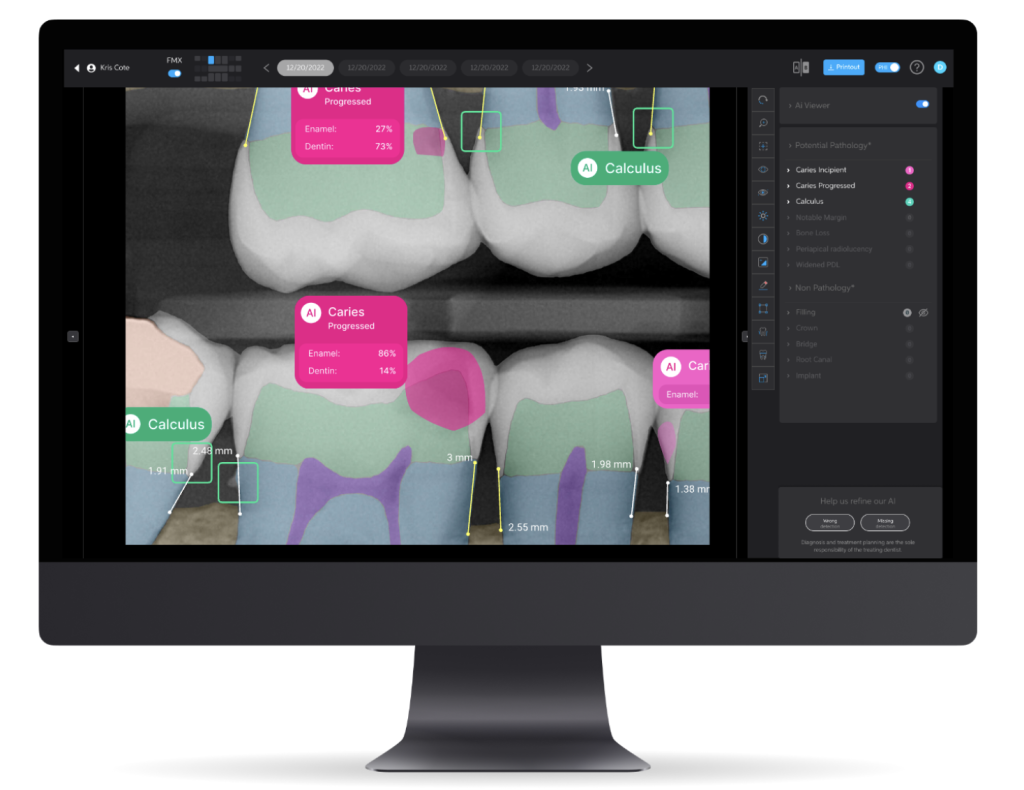 Pearl AI used to detect cavities.