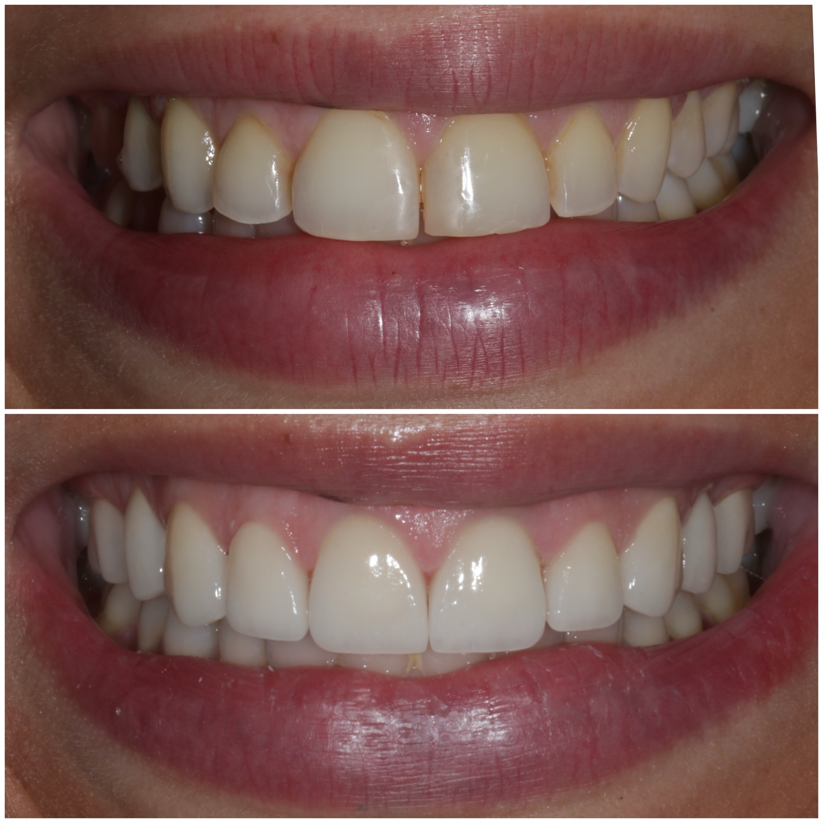 Before and after porcelain veneers by Dr. Nick at Limitless Dental® in Jersey City showing a brighter, more even smile.