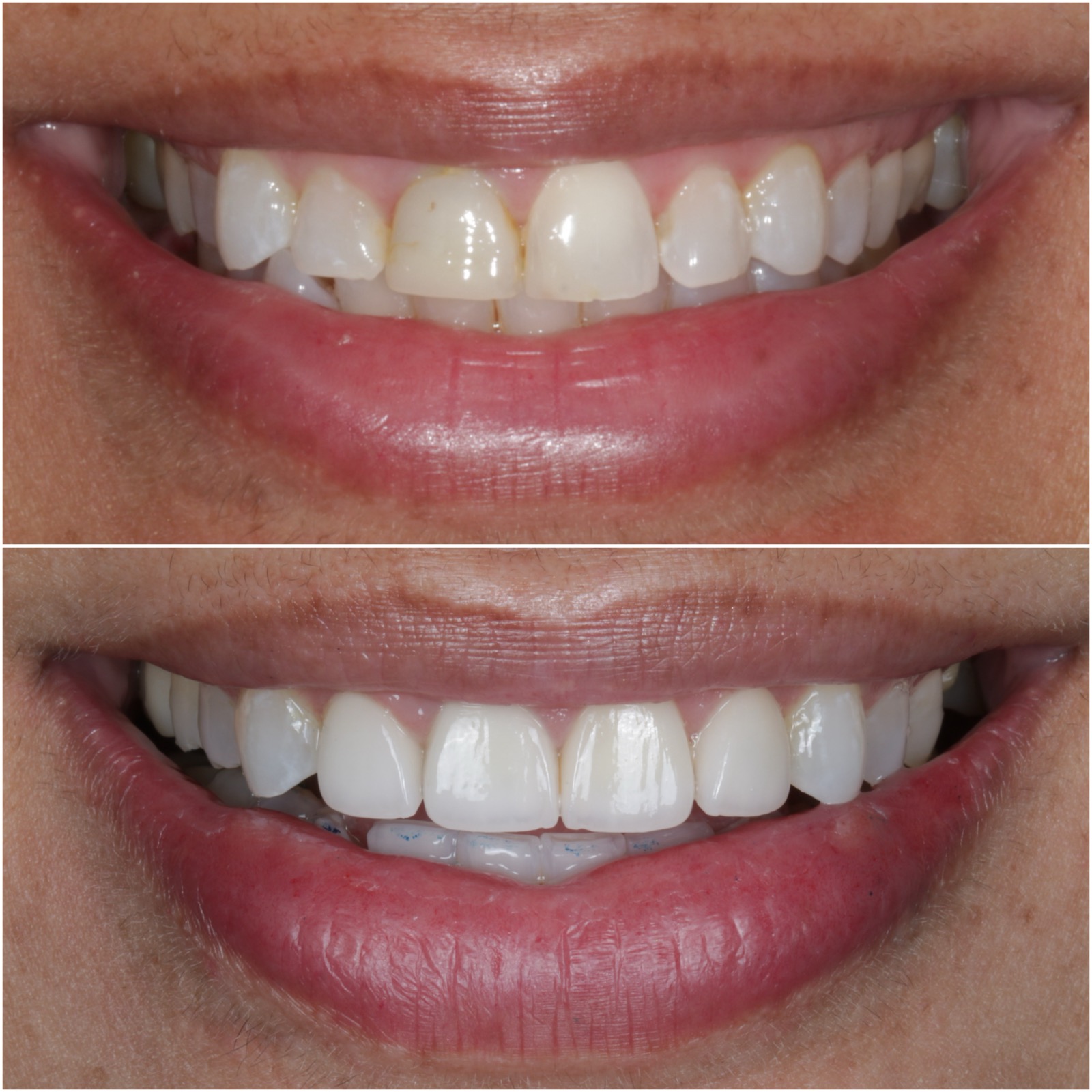 Before and after cosmetic result at Limitless Dental in Jersey City including whitening, clear aligners, and four porcelain veneers by Dr. Nick
