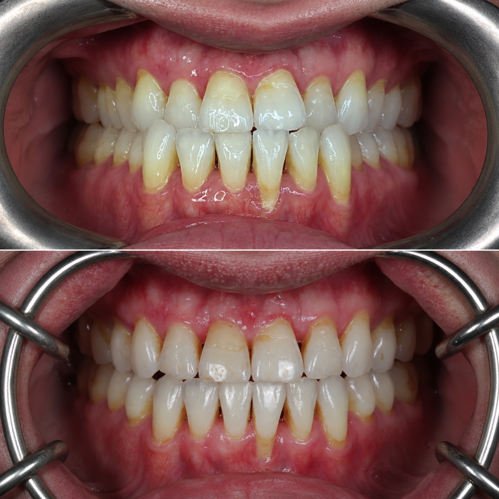 Before and after clear aligner orthodontic treatment result by Dr. Nick Ciardiello at Limitless Dental in Jersey City.